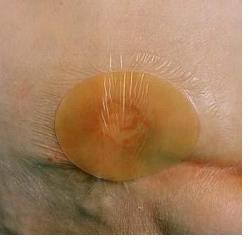 MEDICAZIONE IDROCOLLOIDALE TEGADERM HYDROCOLLOID THIN QUADRATA SENZA BORDO 10X10CM 5 PEZZI